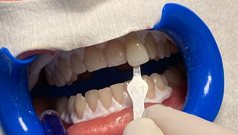 studio dentistico puosi sbiancamento dentale